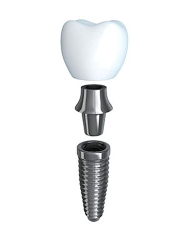 Prosthodontics dental implants